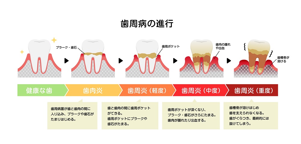 歯周病の進行ステージについて